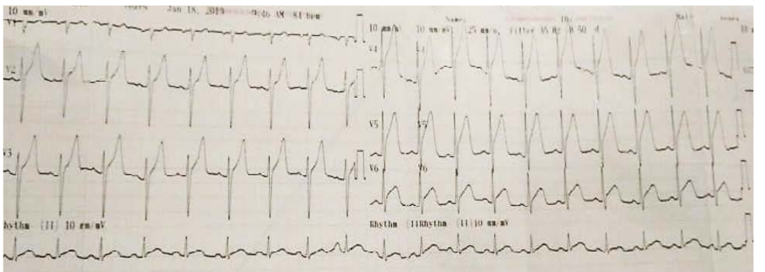 图2:具有超临界AMI的ECG