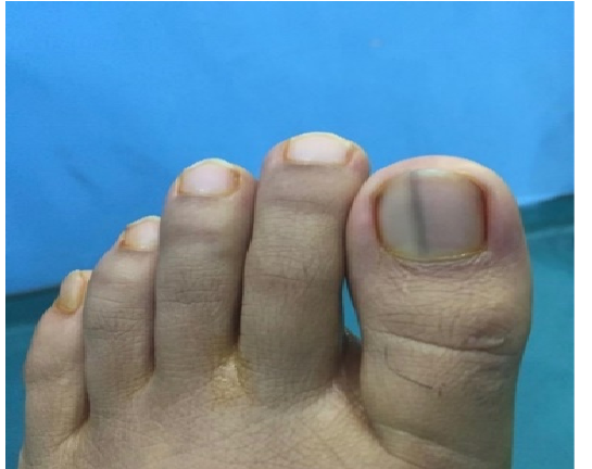 图1:第一个左脚趾甲上的Melanonychia striata