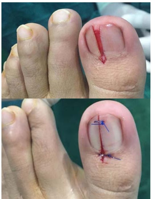 图2:在钉子部分振动程序之后