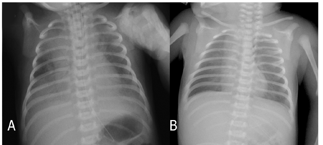 Şekil 1: Pulmonary hemorrhage sırasında ilk hastanın radyografları ve deşarjdan önce