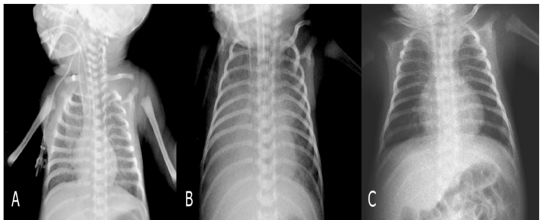 Şekil 2: İkinci hastanın radyografları daha önce ve pulmonary hemorrhage sırasında ve deşarjdan önce