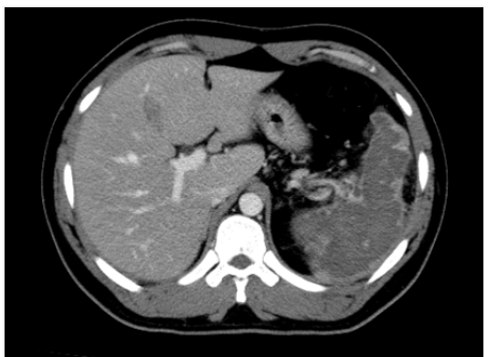 图1:腹部和骨盆对比增强的CT显示出脾梗
