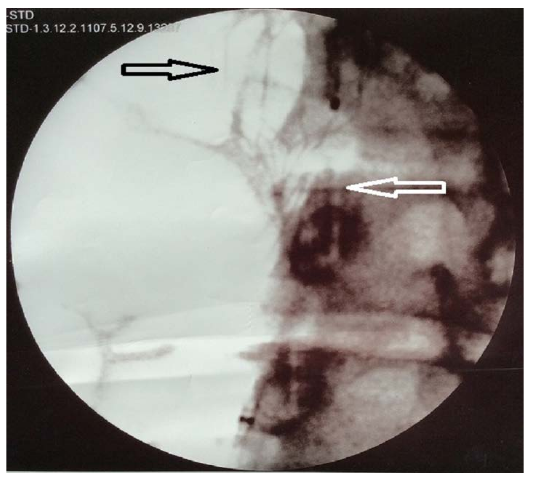 图2:Intraoperatif 面粉图像(黑箭指新临时,白箭指旧永久过滤器).