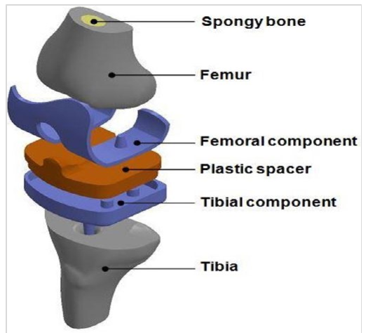 图1:大腿骨、头骨和膝盖总节肢造型的Ansys 3D模型
