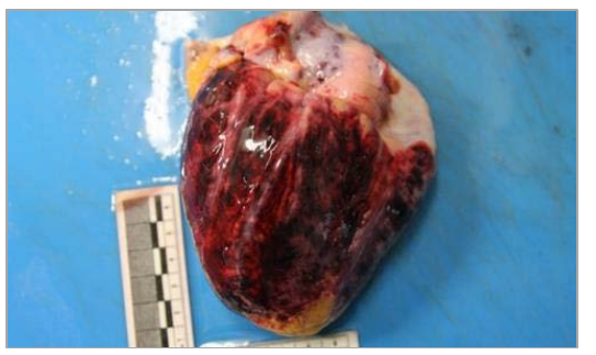 图2:大面积腹腔和腹腔出血