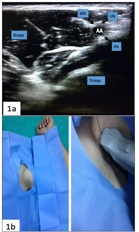 图1:USG对程序期间原子结构的看法(AA:轴动脉,MN:Medial Nerve,联合国:Ulnar Nerve,RN:Radial Nerve) (1b)轴刺侧位置