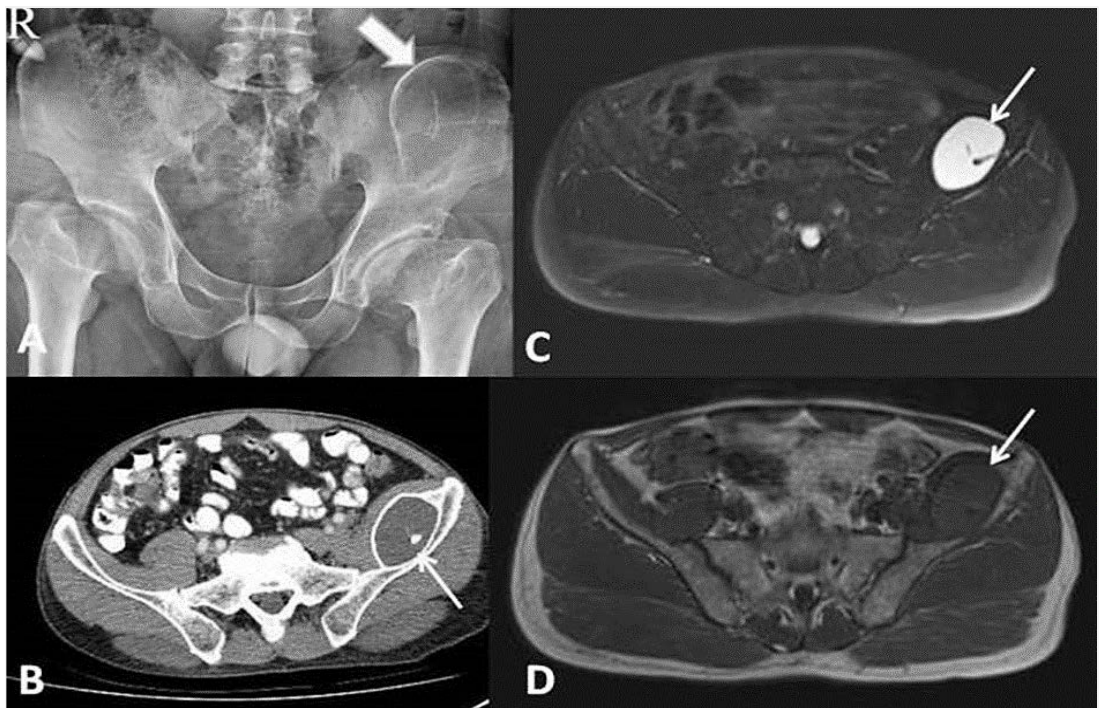 图1: (A) Atero-poster spinvis放射图,显示左侧硅骨(刺箭)上存在大型卵形斜纹. (B) Pelvis CT 显示一个卵形损伤(毛箭),其边缘为斜纹,左侧的iliac fossa水平为低温中心,后部为Ilia
