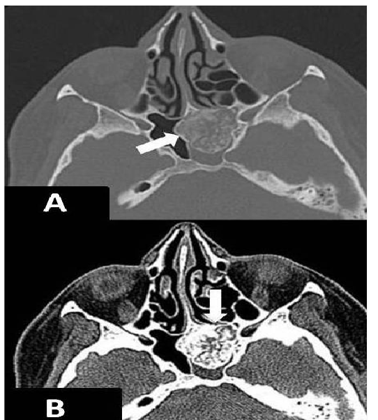 图1:51岁妇女。 轴无增强的CT图像通过Sphenoid sinus. 使用骨算法(A)和parenchyma算法(B)查看时,左侧的sphenoid sinus中可以看到曲线钙化和脂肪(arrows)的多个小分点