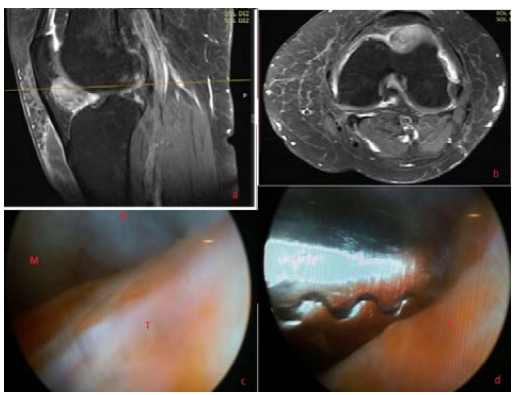 图1:图1a-1b:Frapatellar tenosynoval巨型细胞瘤;预演核磁共振成像和轴突部分.