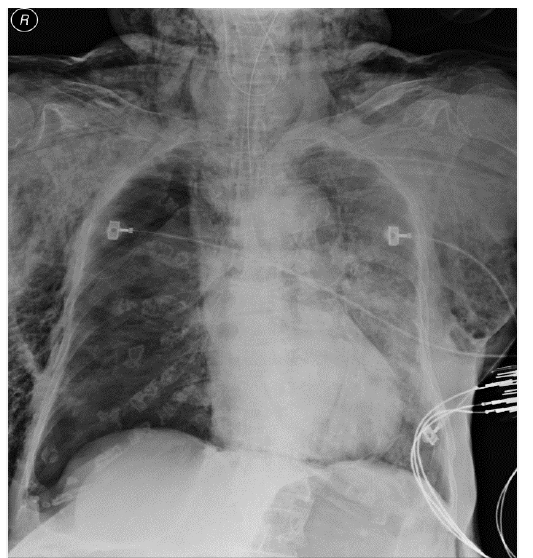 Şekil 1: Bir göğüs X ışını geniş subcutaneous emphysema ve sağ pneumothorax gösterdi.