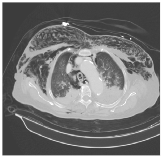 Şekil 2: Tamamlanmış tomografi pneumo medyastinum, sağ pneumothorax ve diff subcuta- neous emphysema over boyun, göğüs ve karın duvarı ortaya koydu.