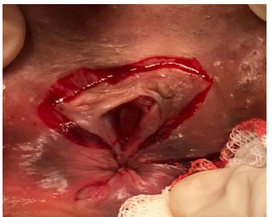 Figure 1: Treatment of Chronic Anal Fissure