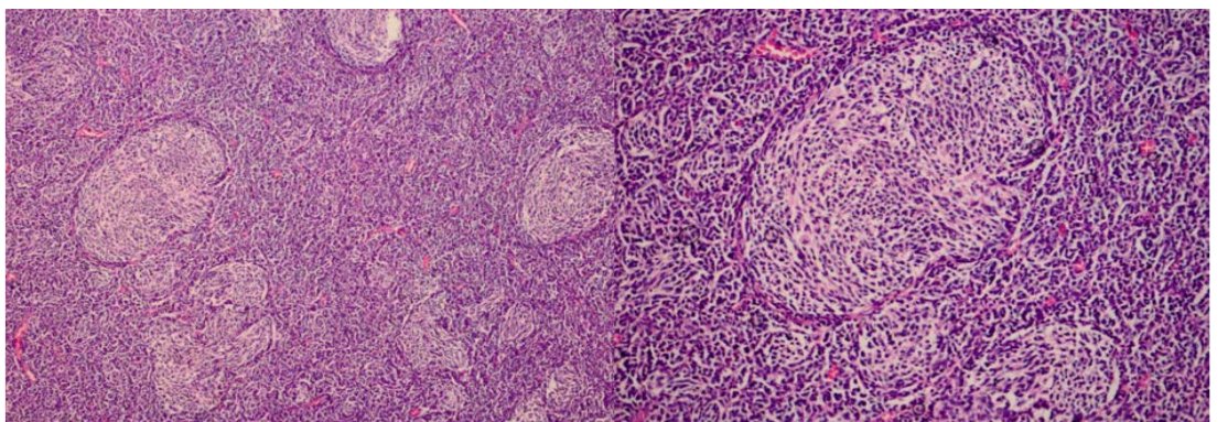 Şekil 3: Desmoplastik medulloblastoma kaydıraklarının ortaya çıkışı, pale fibrillary arka planda (sol panel, magnification 10×). Bir paler tümör nodules üniforma yuvarlak hücreler sunar (sağ panel, magnification 20×).