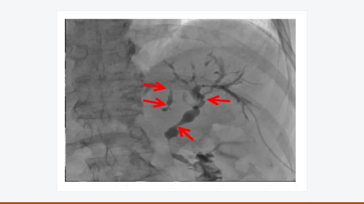 Cholangiogram with red arrows marking multiple narrowings of the bile ducts.