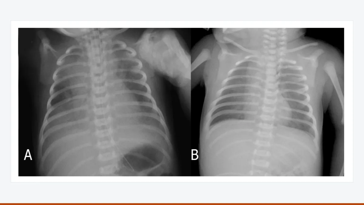 Two chest radiographs of a newborn: (A) during pulmonary haemorrhage and (B) before discharge.