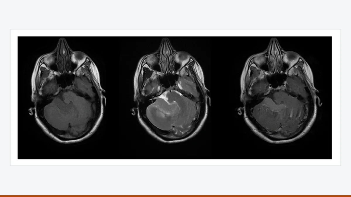 Three axial MRI slices of the brain before surgery showing a tumour in the posterior fossa on different sequences.