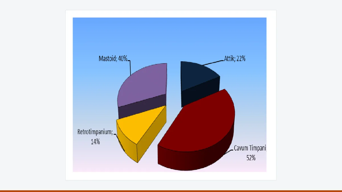 Pie chart of where cholesteatoma was found at revision surgery: cavum tympani, mastoid, attic and retrotympanum.