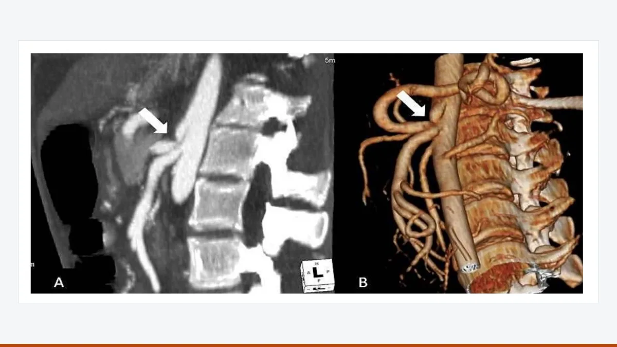 CT angiography images, a sagittal slice and a 3D reconstruction, with arrows pointing to a hook-like narrowing at the start of the coeliac artery.