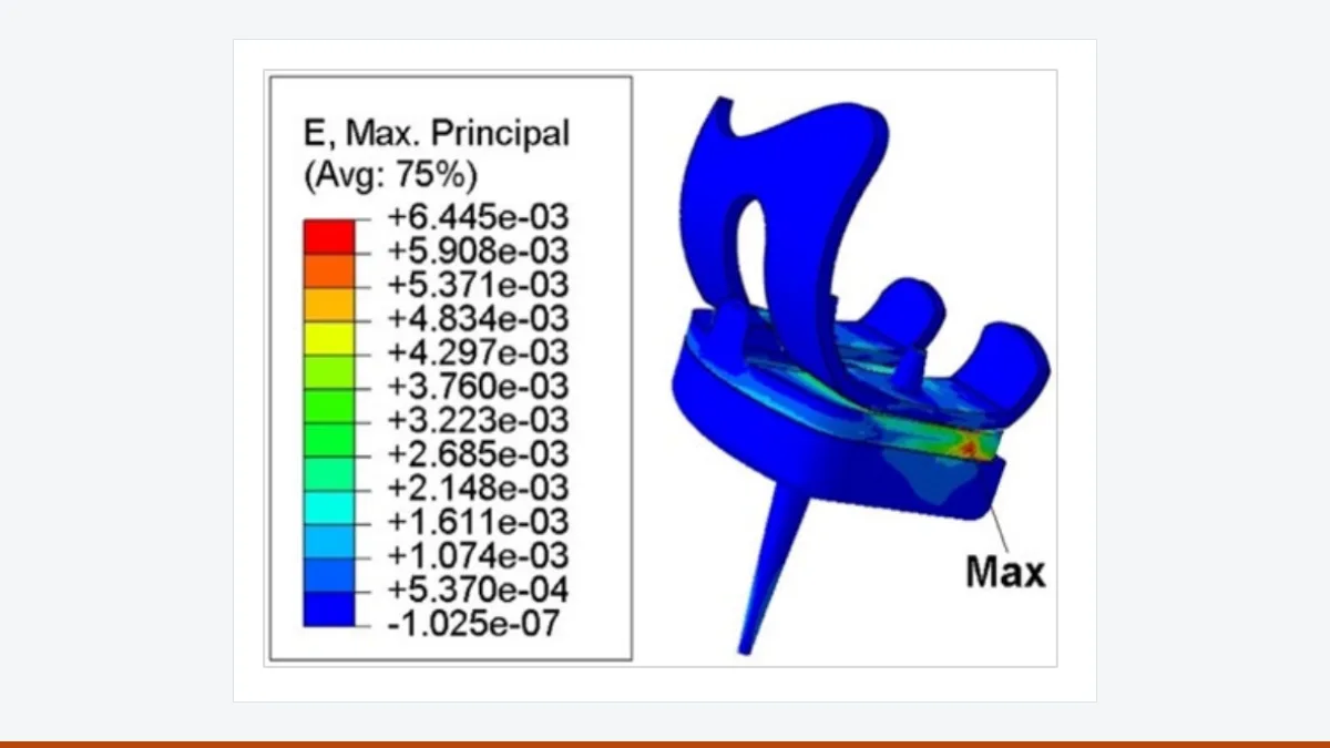 Finite element model of a knee implant with a colour scale of maximum principal stress; the highest values lie on the medial side of the polyethylene insert.